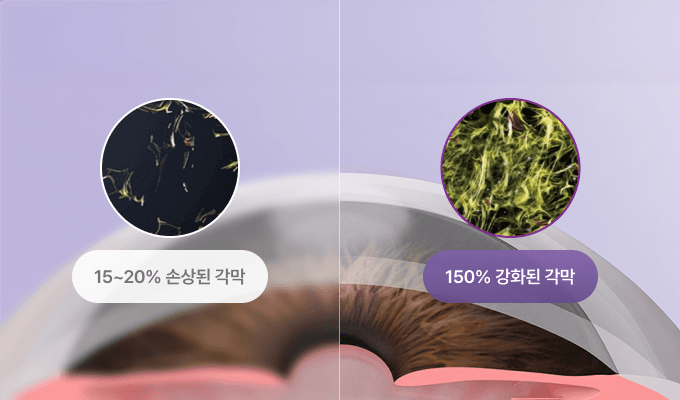 각막강화술 전후 비교