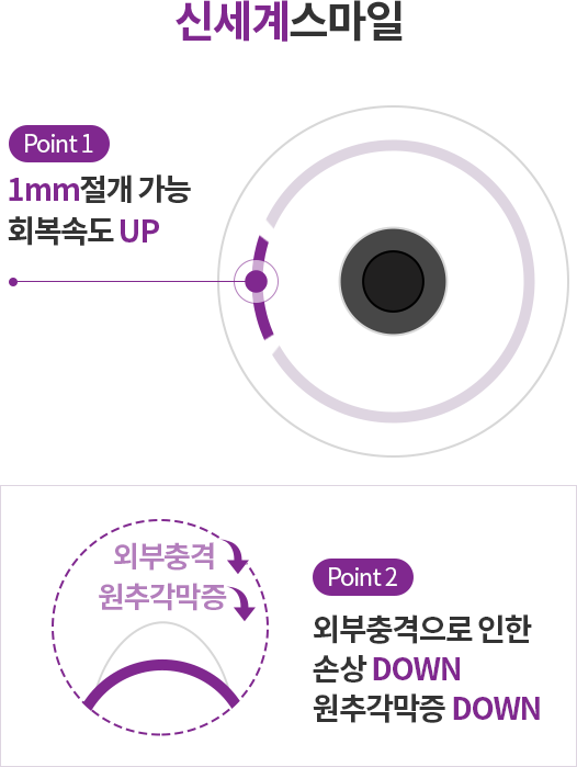 point1. 1mm 절개 가능 회복속도 UP, point2. 외부충격 up 원추각막증 down