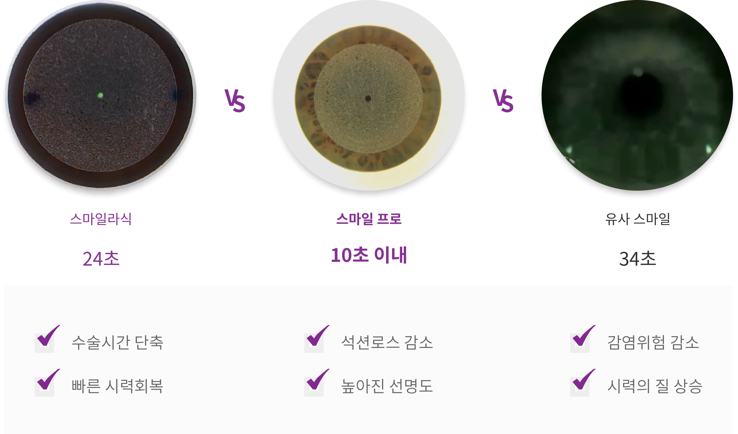 장비별 스마일 수술 시간 비교 이미지